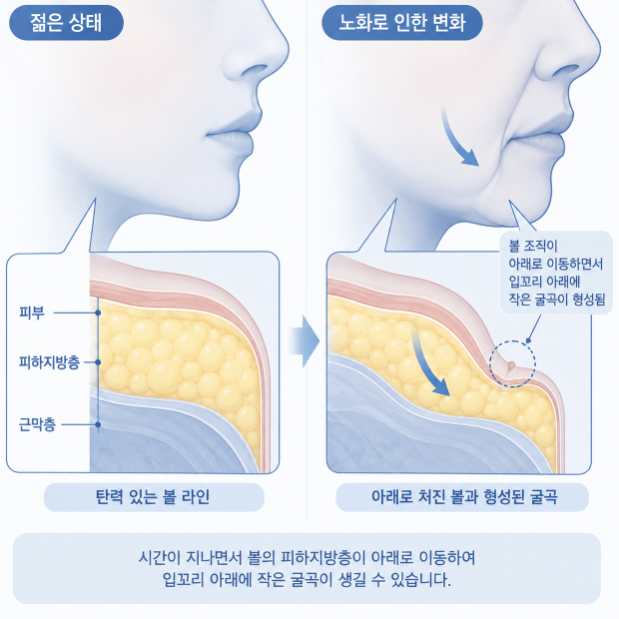 마리오네트주름, 입가에서 턱까지 깊어지는 이유는 무엇일까? 사진 6