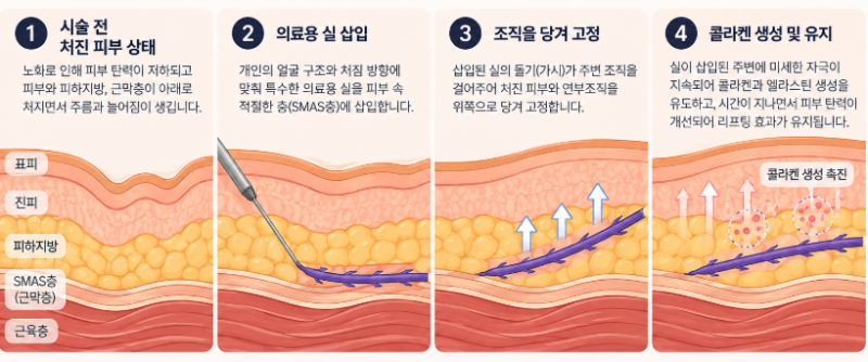 신논현실리프팅, 같은 시술인데 결과가 달라지는 이유는? 사진 3