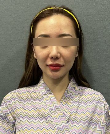 신논현실리프팅, 같은 시술인데 결과가 달라지는 이유는? 사진 14