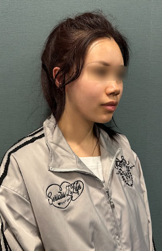신논현실리프팅, 같은 시술인데 결과가 달라지는 이유는? 사진 13