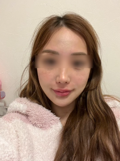 신논현실리프팅, 같은 시술인데 결과가 달라지는 이유는? 사진 15