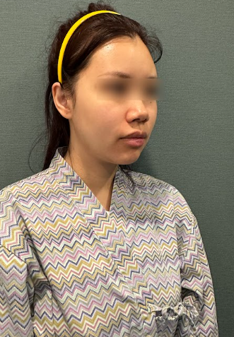 신논현실리프팅, 같은 시술인데 결과가 달라지는 이유는? 사진 12
