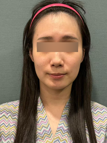 신논현실리프팅, 같은 시술인데 결과가 달라지는 이유는? 사진 6