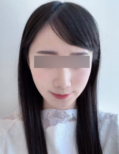 신논현실리프팅, 같은 시술인데 결과가 달라지는 이유는? 사진 7