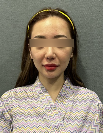 신논현리프팅잘하는곳, 같은 시술인데 결과가 달라지는 이유는? 사진 5