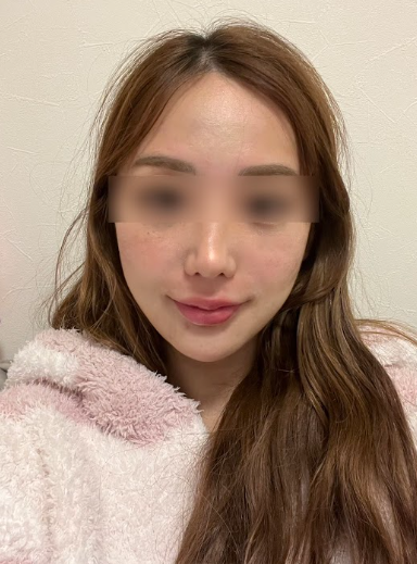 신논현리프팅잘하는곳, 같은 시술인데 결과가 달라지는 이유는? 사진 6