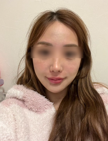 40대 50대 60대 리프팅, 안면거상까지 고려해야 하는 순간 사진 6
