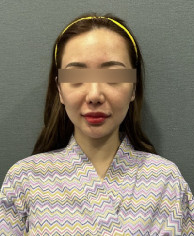 40대 50대 60대 리프팅, 안면거상까지 고려해야 하는 순간 사진 5