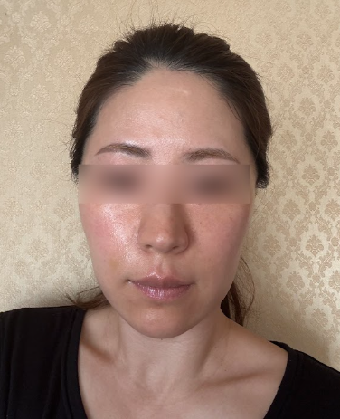 40대 50대 60대 리프팅, 안면거상까지 고려해야 하는 순간 사진 8