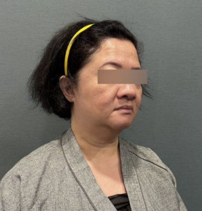 서울안면거상술, 리프팅을 받아도 처짐이 반복된다면? 사진 6