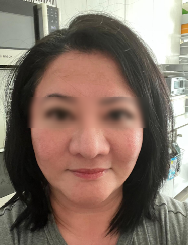 서울안면거상술, 리프팅을 받아도 처짐이 반복된다면? 사진 7