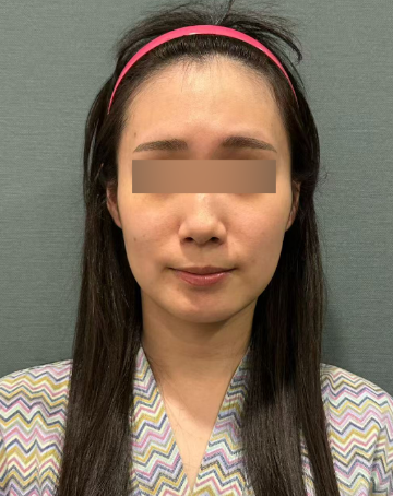 실리프팅팔자주름, 깊어진 주름도 개선할 수 있을까? 사진 7
