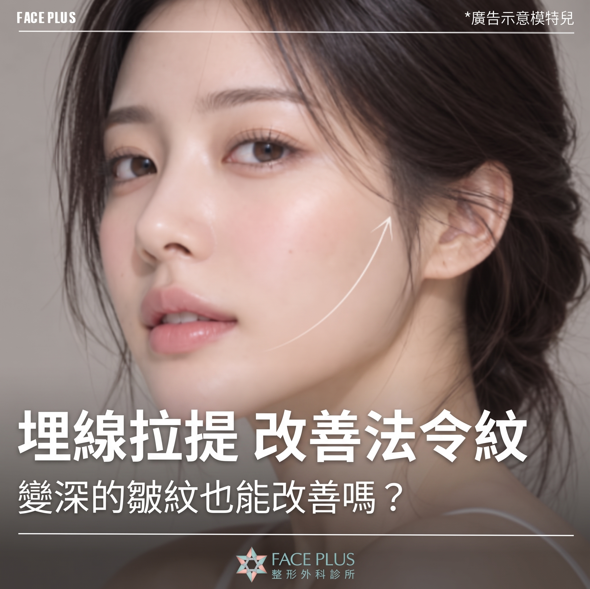 埋線拉提改善法令紋，已加深的皺紋也能改善嗎？