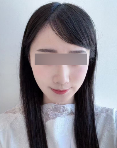 실리프팅팔자주름, 깊어진 주름도 개선할 수 있을까? 사진 8
