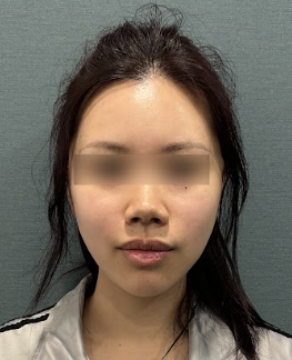 팔자주름리프팅, 효과와 유지기간은 얼마나 될까? 사진 7