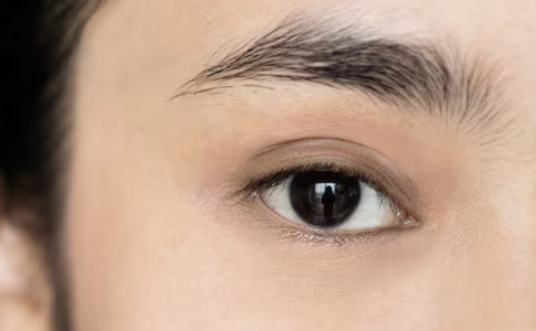 눈처짐 리프팅, 상안검수술과 눈썹하거상술 어떻게 다를까? 사진 3