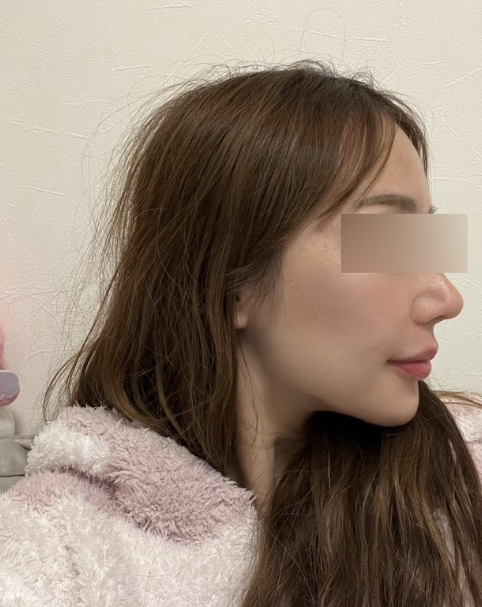 압토스실리프팅, 일반 실리프팅과 어떤 차이가 있을까? 사진 5