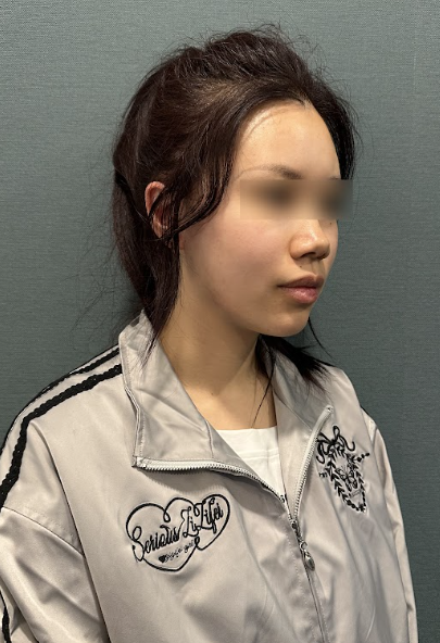 땅콩형, 중안부가 길어 보이고 둥근턱선까지 고민이라면? 사진 8