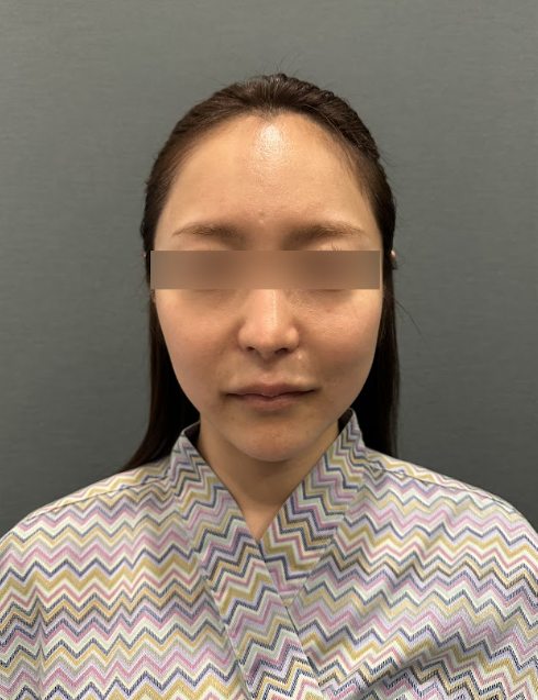 땅콩형, 중안부가 길어 보이고 둥근턱선까지 고민이라면? 사진 3
