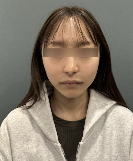 땅콩형, 중안부가 길어 보이고 둥근턱선까지 고민이라면? 사진 4