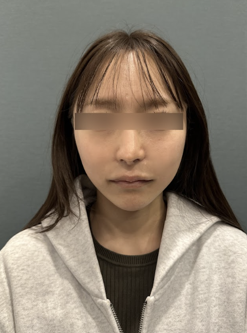 땅콩형, 중안부가 길어 보이고 둥근턱선까지 고민이라면? 사진 10