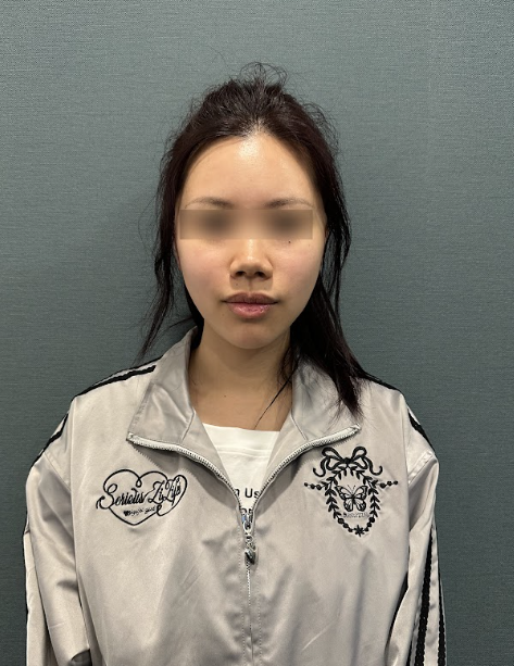 얼굴주름리프팅, 깊어진 주름까지 리프팅으로 개선할 수 있을까? 사진 6