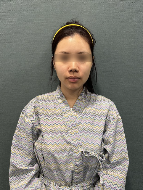 얼굴주름리프팅, 깊어진 주름까지 리프팅으로 개선할 수 있을까? 사진 5
