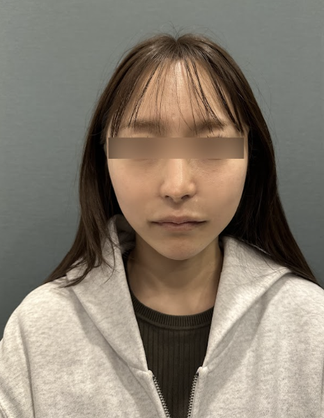 녹는실리프팅, 실 종류에 따라 유지기간이 달라질까? 사진 4