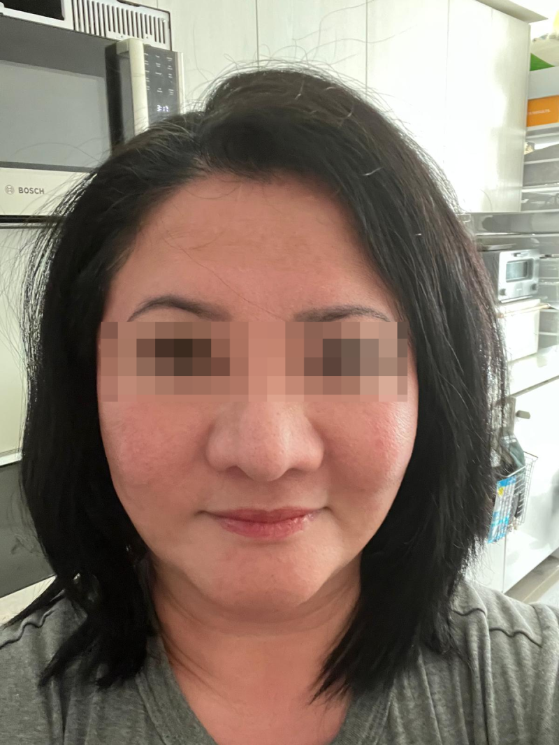 미니거상 가격, 일반 안면거상보다 저렴할까? 흉터와 유지기간까지 사진 8